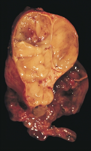 Tumour of thymus gland